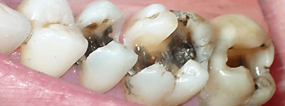 Последняя стадия кариозной болезни сопровождается обширным распространением патологии на твердые ткани зуба и приводит к их необратимому разрушению